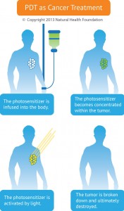 Photodynamic Therapy