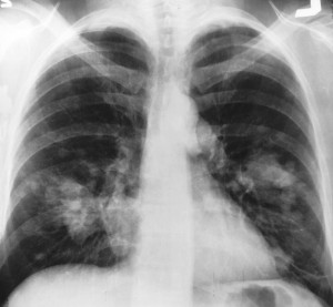 Chest X-Ray LungCa