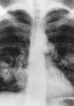 Chest X-Ray LungCa
