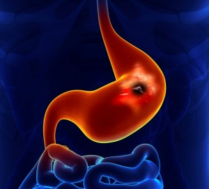 gastric and stomach cancer