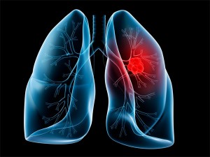 lung_cancer