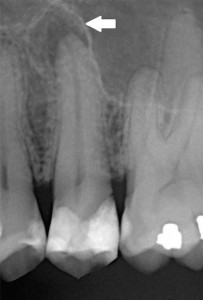 Periodontitis_small