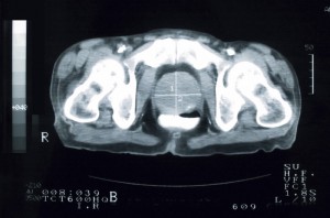 prostate_cancer_xray