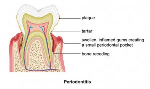 Periodontal_disease