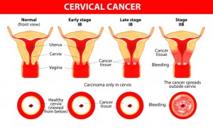 cervical_cancer